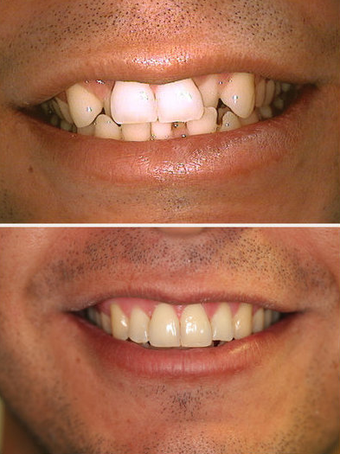 Invisalign before 145505