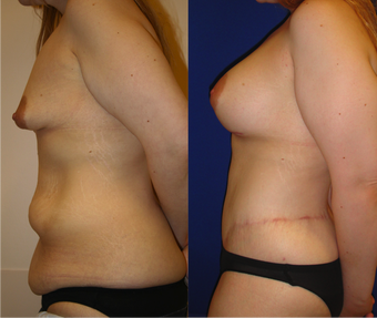 Lower Body lift, Breast Augmentation 543105