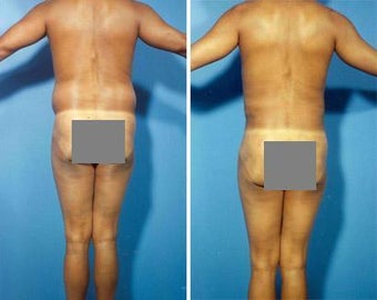 Liposuction before 636264