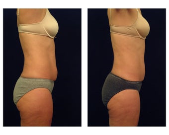 Liposuction 397032