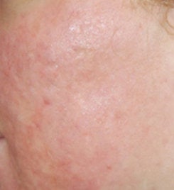 Acne Scar Vitalizer Treatment after 562078