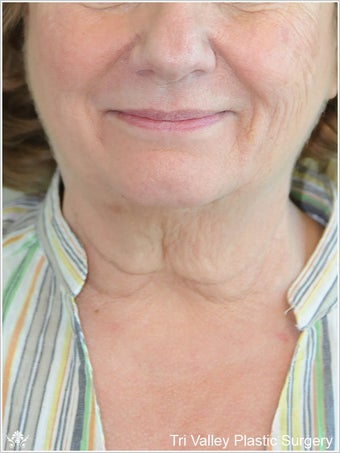 Facelift before 420916