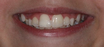 Cosmetic Composite Resin for Broken Front Tooth in Teenager after 463699