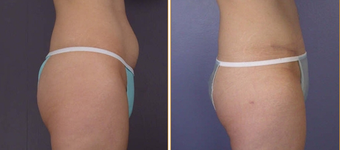 Liposuction before 270014