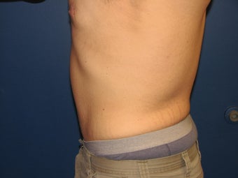 Male Tummy Tuck 576569