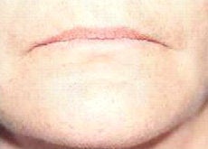 Lip Augmentation before 341058