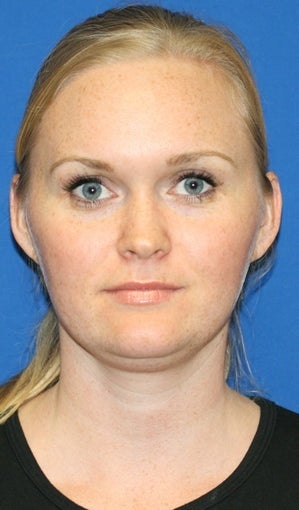 1 month post op: Necklift & Neck Liposuction 480354