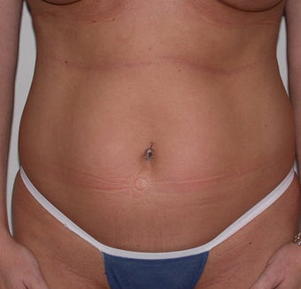 Liposuction before 313778