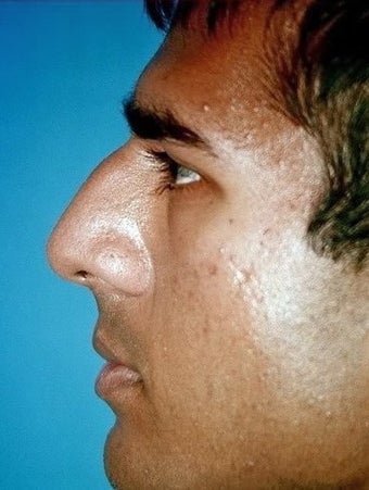 Rhinoplasty before 296744