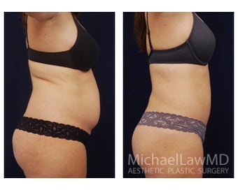 Liposuction 392397