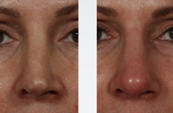Revision Rhinoplasty after 358999