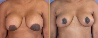 Breast Implant Removal before 270062