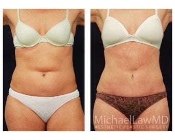 Abdominoplasty - Tummy Tuck before 396121