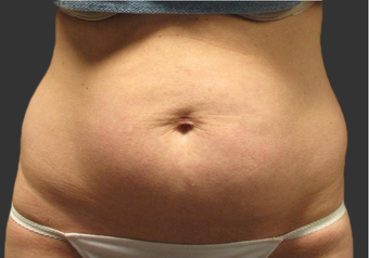 Exilis before 423764