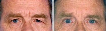Blepharoplasty before 643241