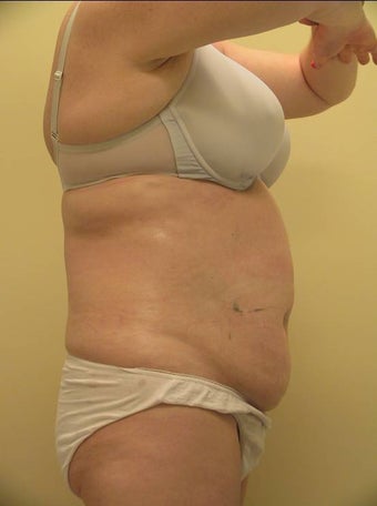 Ultrashape after 234224