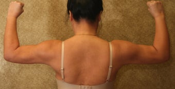 liposuction of arms for women 583554