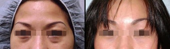 Lower Eyelid(Blepharoplasty) Surgery before 650663
