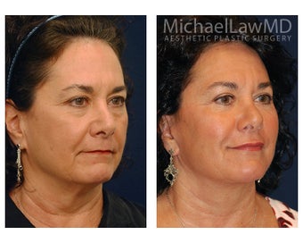 Facial Rejuvenation - Lower Face Lift after 395206