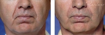 Restylane (Filler) before 110124