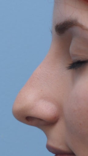 Rhinoplasty after 361321