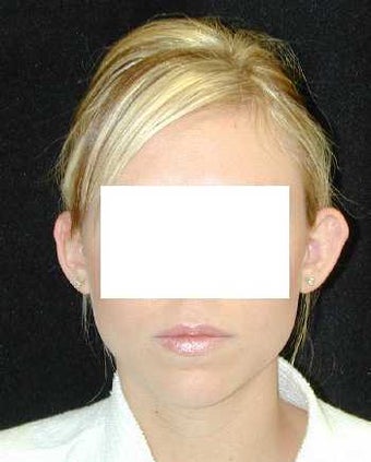 Otoplasty - Ear Surgery before 215191
