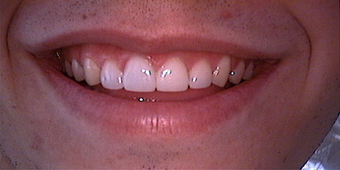 Veneers and crowns after 145694