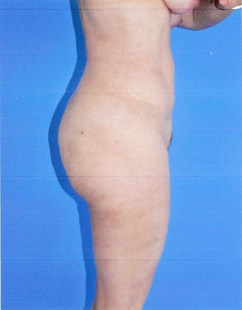 Liposuction after 500014