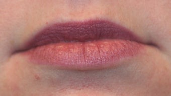 Restylane and botox used to augment the lips before 240184
