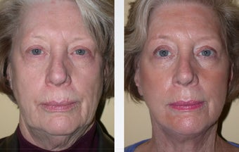 Necklift before 359788