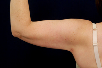 Liposuction - Upper Arms 393164