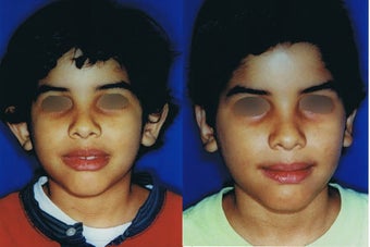 Otoplasty for Protruding Ears before 117346