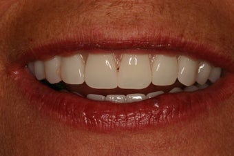 Same day implant supported teeth. after 350499