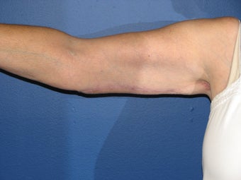 Brachioplasty after 575818