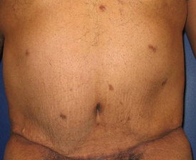 Body Lift after 95741