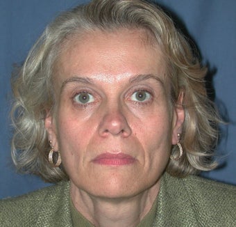 Liquid Facelift for Nasolabial Folds before 104598