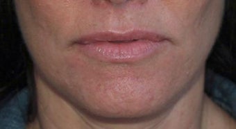 Lip Augmentation before 399260