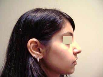 Rhinoplasty after 137959