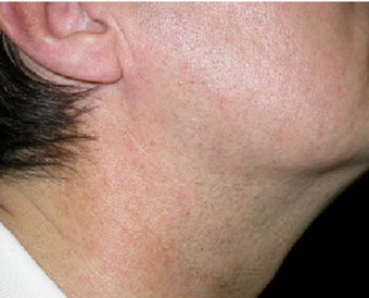 VBeam treatment for neck redness after 123283