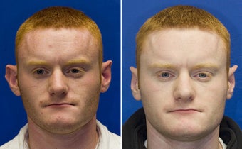 Otoplasty before 233035