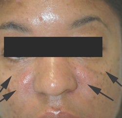 Treatment for Laugh lines after 93350