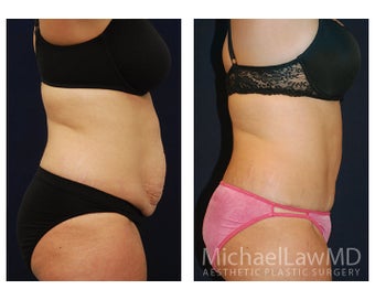 Abdominoplasty - Tummy Tuck 396176