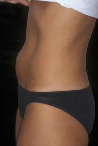 CoolSculpting treatment of unwanted tummy fat before 359376
