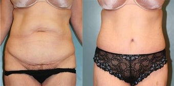 Tummy Tuck before 218300