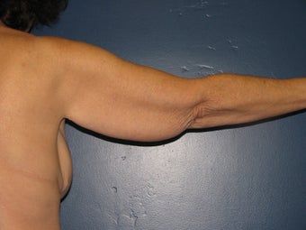 Brachioplasty 575818