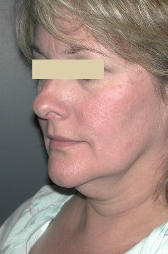 Facelift before 137047