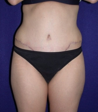 Tummy Tuck (abdominoplasty) after 208468