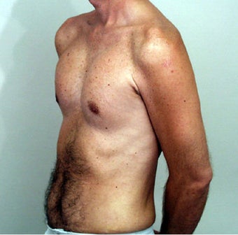 Male Chest Enhancement after 525477