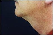 Chin Augmentation after 205406