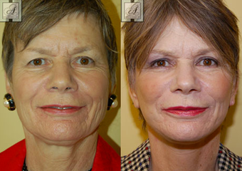 Facelift before 314256